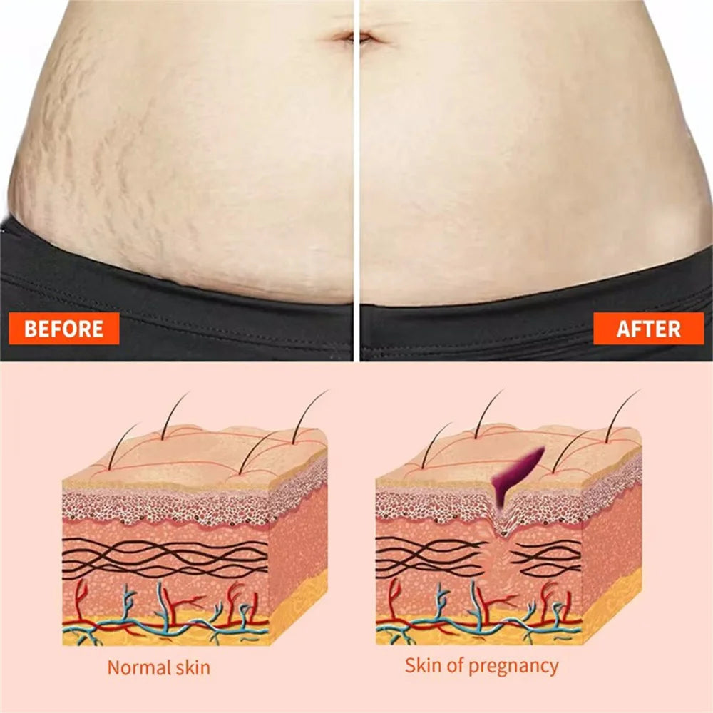 Stretch Marks Remover Essential Oil Pregnancy Maternity Body New Old Stretch Mark Removal Serum Increase Elasticity of Skin