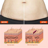 Stretch Marks Remover Essential Oil Pregnancy Maternity Body New Old Stretch Mark Removal Serum Increase Elasticity of Skin