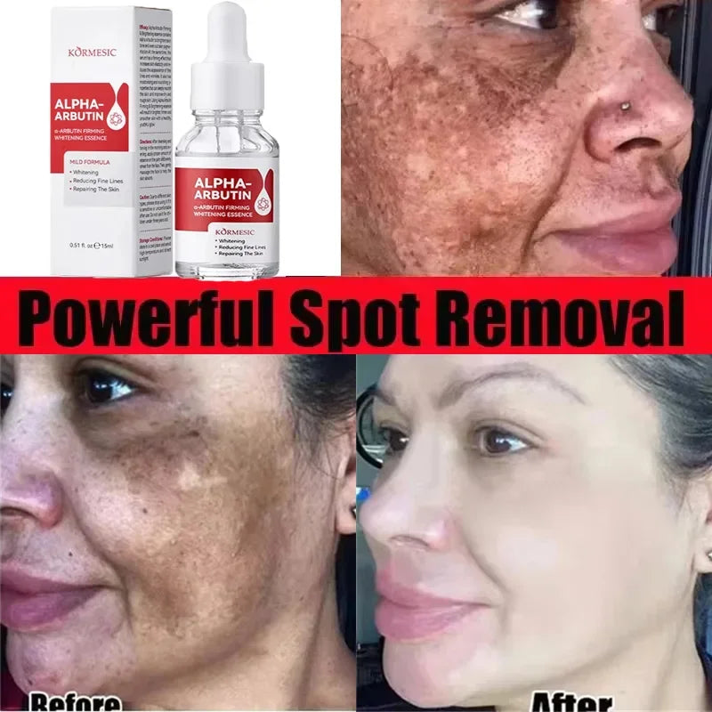 Powerful Dark Spots Remover Whitening Serum Face Freckle Melanin Correcting Anti Pigmentation Brighten Skin Beauty Care Essence