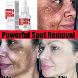 Powerful Dark Spots Remover Whitening Serum Face Freckle Melanin Correcting Anti Pigmentation Brighten Skin Beauty Care Essence