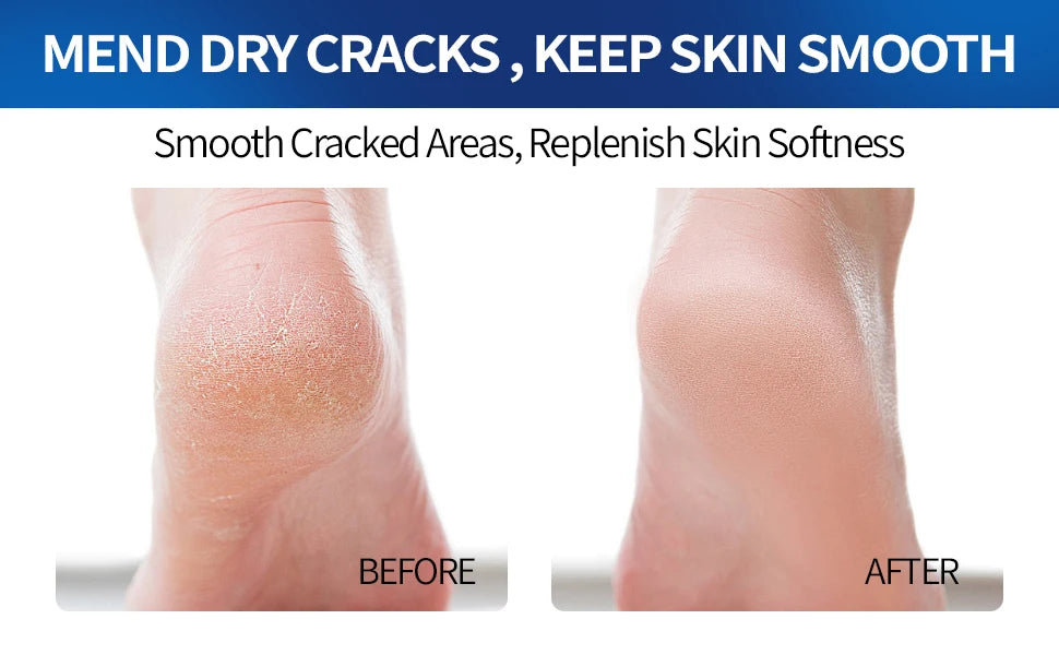 60% Urea Foot Cream Stick with 2% Salicylic Acid, Foot Care Cream Moisturizer for Dry Cracked Feet, Knees, Hands, Moisturizes Skin