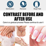 South Moon Nail Fungus Repair Pen Remove Onychomycosis Paronychia Reduce Toe Infection Brighten Nail Hand Foot Nail Care Liquid