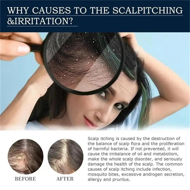 Fast Anti Exfoliating Scrub Remove Dandruff Anti Itching Treatment Seborrheic Scalp Oil Control Repair Scalp Beauty Health Care