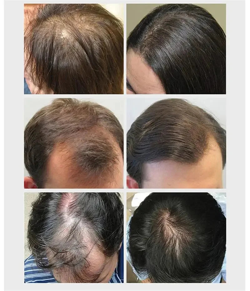 Hair Growth Serum 7 Days Fast Regrowth Essential Capsule Anti Hair Loss Baldness Repair Damaged Scalp Treatment For Women Men