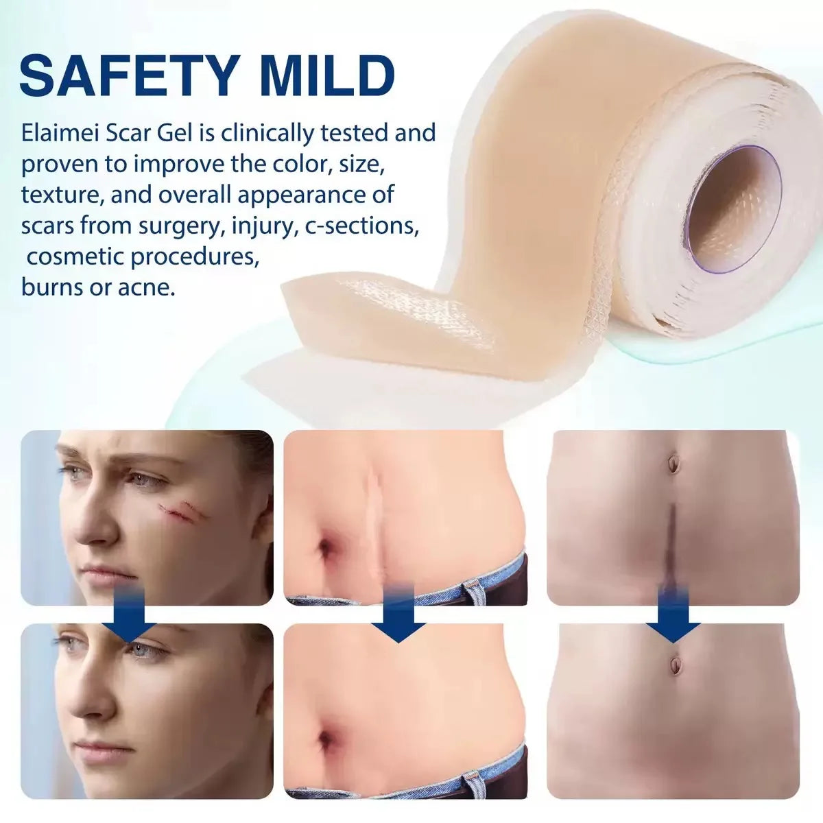 4cmx50cm Silicone Scar Sheet Painless Scar Repair Tape Removal Strip for C-Section Keloid Surgery Burn Acne Roll Effective Scar