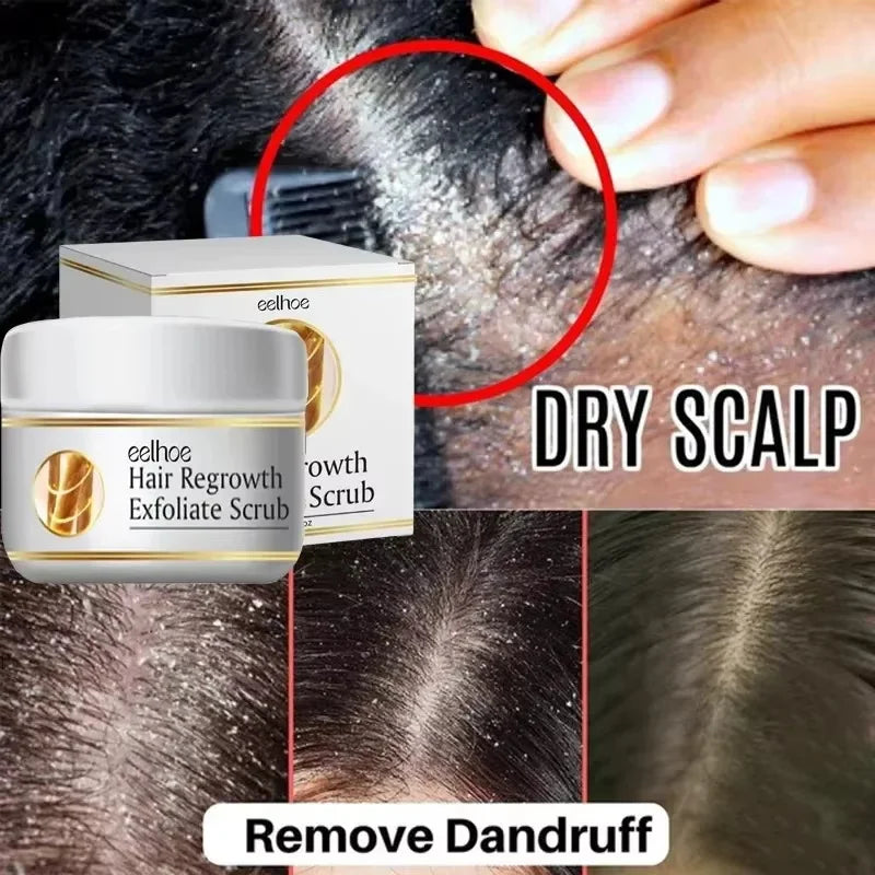 Fast Anti Exfoliating Scrub Remove Dandruff Anti Itching Treatment Seborrheic Scalp Oil Control Repair Scalp Beauty Health Care