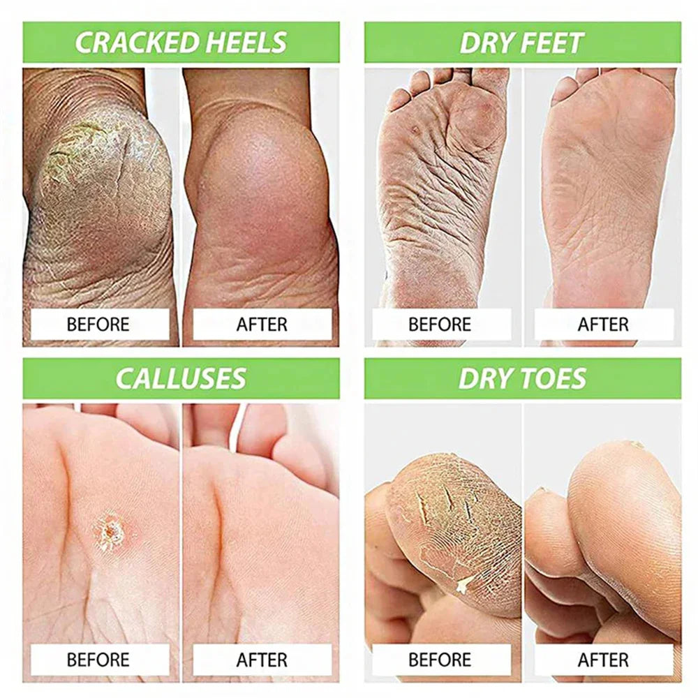 Herbal Anti Crack Foot Cream Spray Heel Cracking Repair Products Exfoliation Dead Skin Removal Softening Moisturize Smooth Care