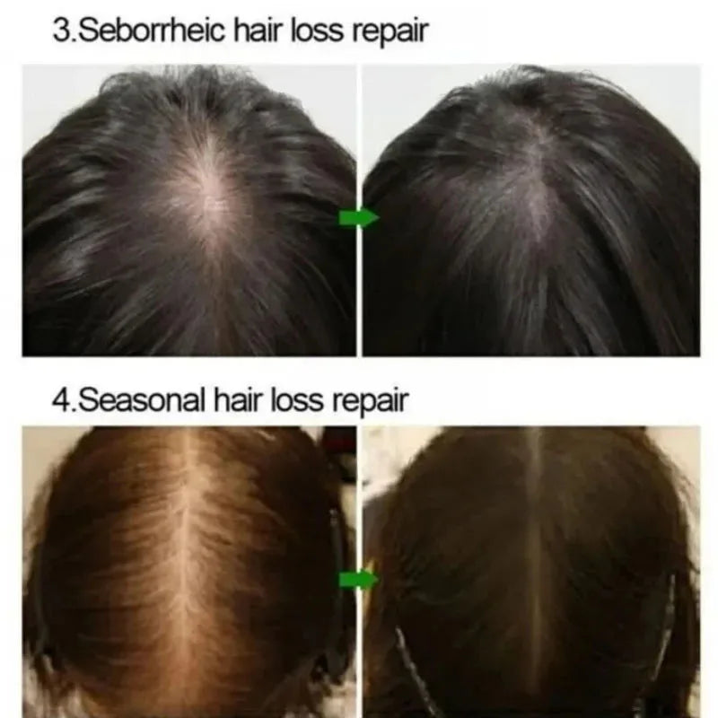 Hair Growth Serum 7 Days Fast Regrowth Essential Capsule Anti Hair Loss Baldness Repair Damaged Scalp Treatment For Women Men