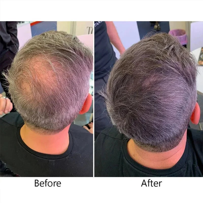 Hair Growth Serum 7 Days Fast Regrowth Essential Capsule Anti Hair Loss Baldness Repair Damaged Scalp Treatment For Women Men
