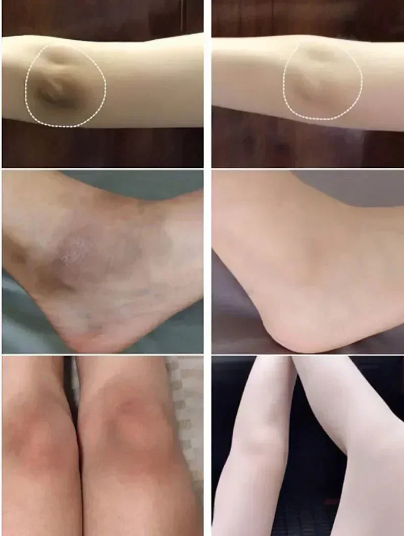 Whitening Cream Private Parts Underarm Bleaching Whiten Butt Knee Brighten Inner Thigh Intimate Parts Dark Remove Melanin
