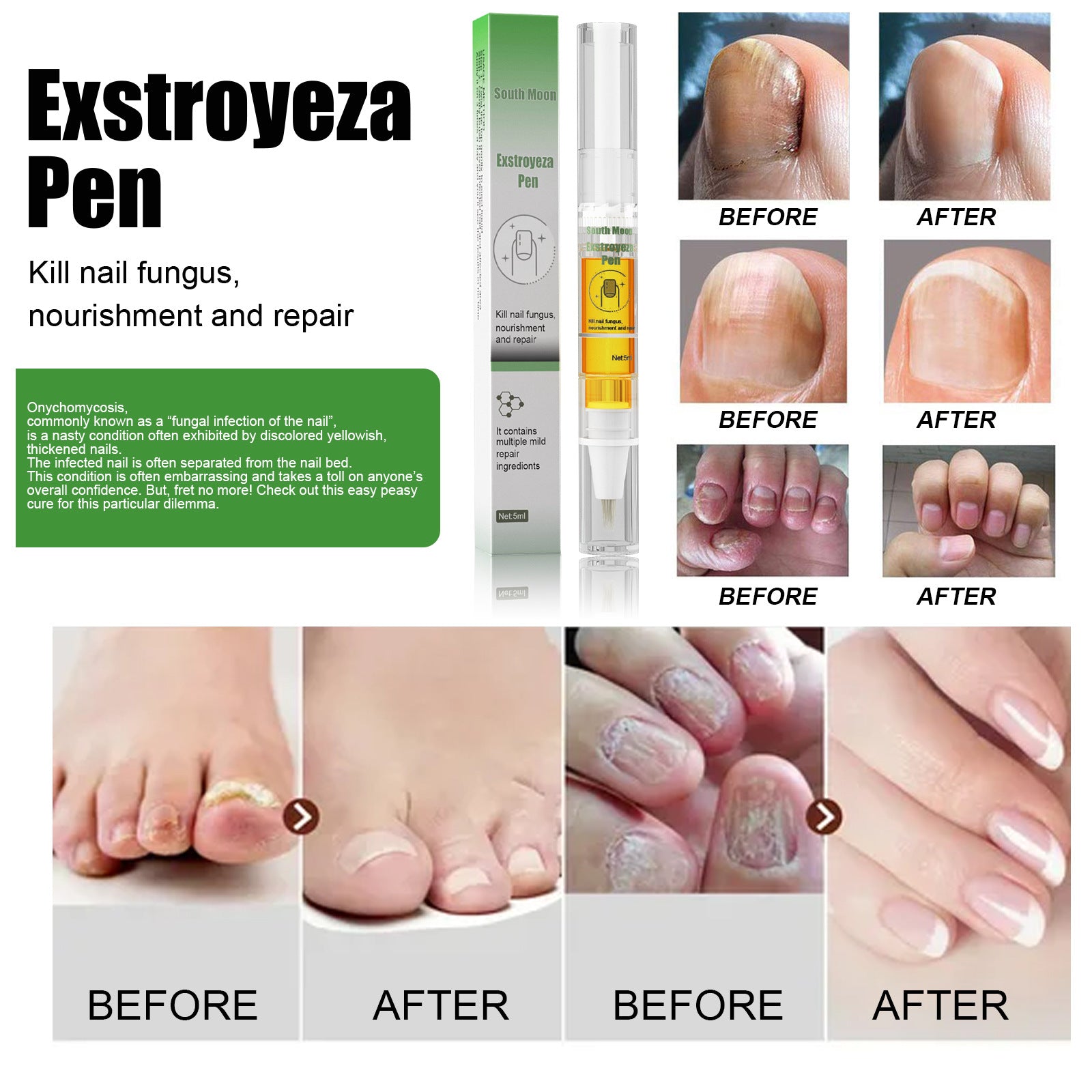 South Moon Nail Fungus Repair Pen Remove Onychomycosis Paronychia Reduce Toe Infection Brighten Nail Hand Foot Nail Care Liquid