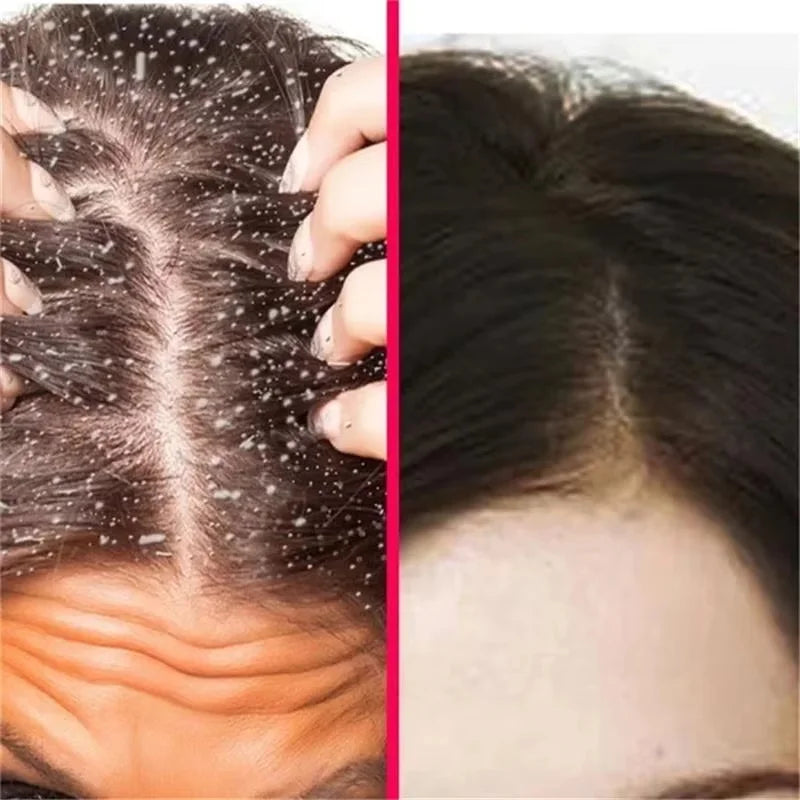 Fast Anti Exfoliating Scrub Remove Dandruff Anti Itching Treatment Seborrheic Scalp Oil Control Repair Scalp Beauty Health Care
