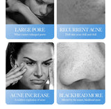 BIOAQUA Salicylic Acid Face Cream Acne Creams Mark Repair Firming Moisturizing Blackhead Remover skincare Facial Cream