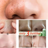Original Facial Remove Blackhead Green Tea Solid Mask Treat Acne Blemish Black Dots Clean Stick Cream Shrink Pores Skin Care  ﻿