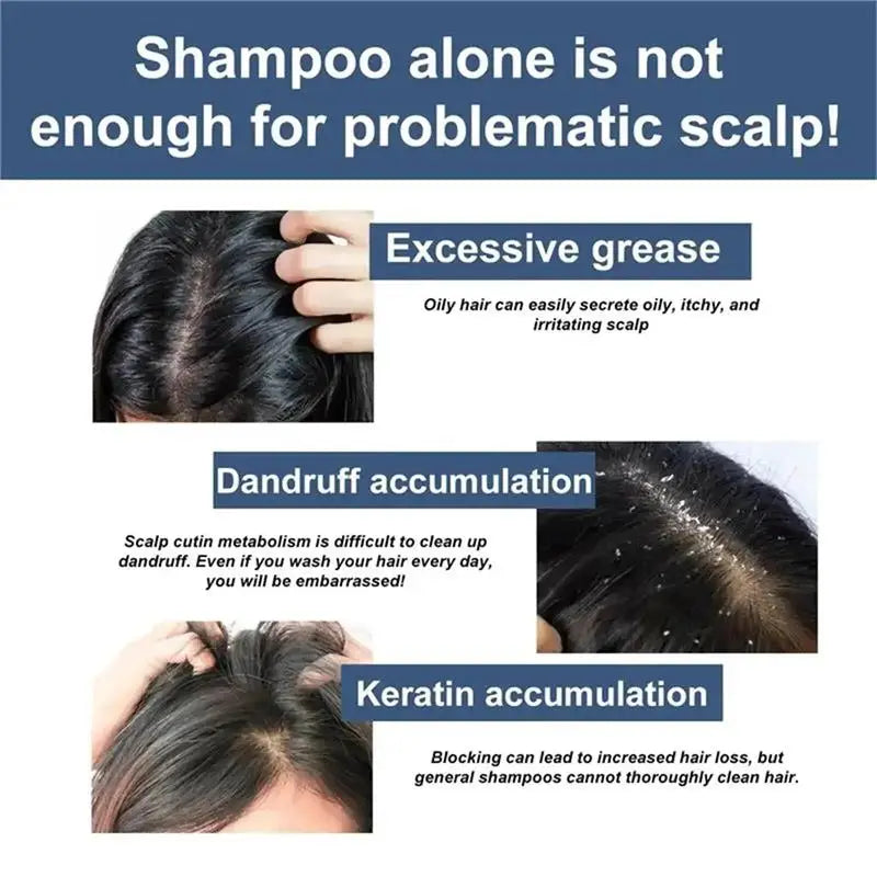 Fast Anti Exfoliating Scrub Remove Dandruff Anti Itching Treatment Seborrheic Scalp Oil Control Repair Scalp Beauty Health Care