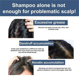 Fast Anti Exfoliating Scrub Remove Dandruff Anti Itching Treatment Seborrheic Scalp Oil Control Repair Scalp Beauty Health Care