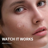 36pcs Skin-Calming Acne Patches - Hydrocolloid Technology Gently Heals Blemishes, invisibleProtection.