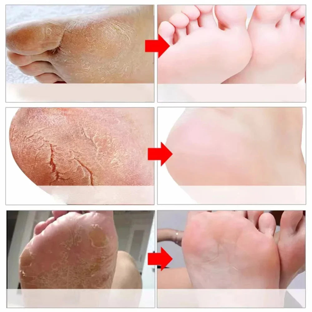 Herbal Anti Crack Foot Cream Heel Cracking Repair Products Exfoliation Dead Skin Removal Softening Moisturize Smooth Skin Care
