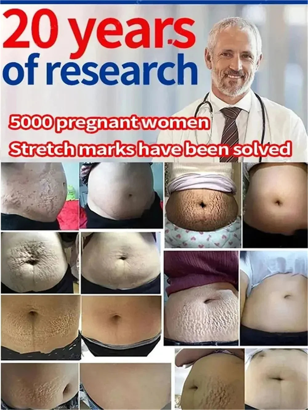 Stretch Marks Remover Essential Oil Pregnancy Maternity Body New Old Stretch Mark Removal Serum Increase Elasticity of Skin