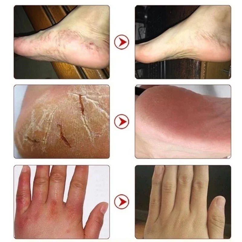 Herbal Anti Crack Foot Cream Heel Cracking Repair Products Exfoliation Dead Skin Removal Softening Moisturize Smooth Skin Care