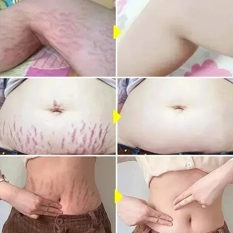 Cream For Pregnancy Stretch Marks Removal Eliminate Red White Old Stretch Marks  2025
