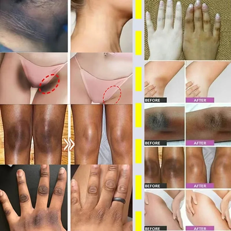Niacinamide Whitening Cream Stick Remove Dark Spots Bleaching Private Parts Underarm  Brighten Butt Knee Inner Thigh Body Care