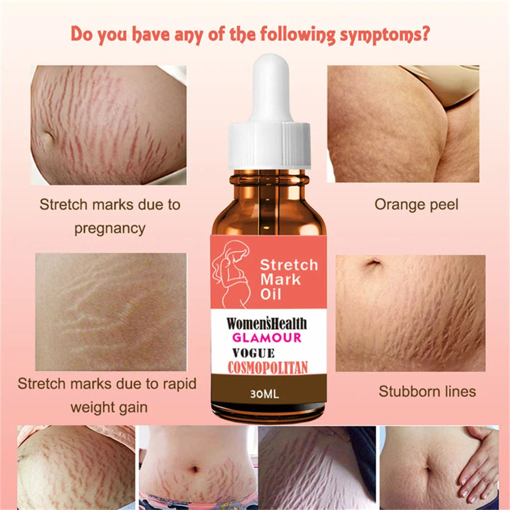 Stretch Marks Remover Essential Oil Pregnancy Maternity Body New Old Stretch Mark Removal Serum Increase Elasticity of Skin