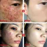 Original Facial Remove Blackhead Green Tea Solid Mask Treat Acne Blemish Black Dots Clean Stick Cream Shrink Pores Skin Care  ﻿