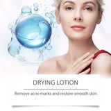 Salicylic Acid Serum for Acne Drying Lotion Acne Treatment Sensitive Skin Care Pimples Acne Remover Serum Cream Anti Acne Serum