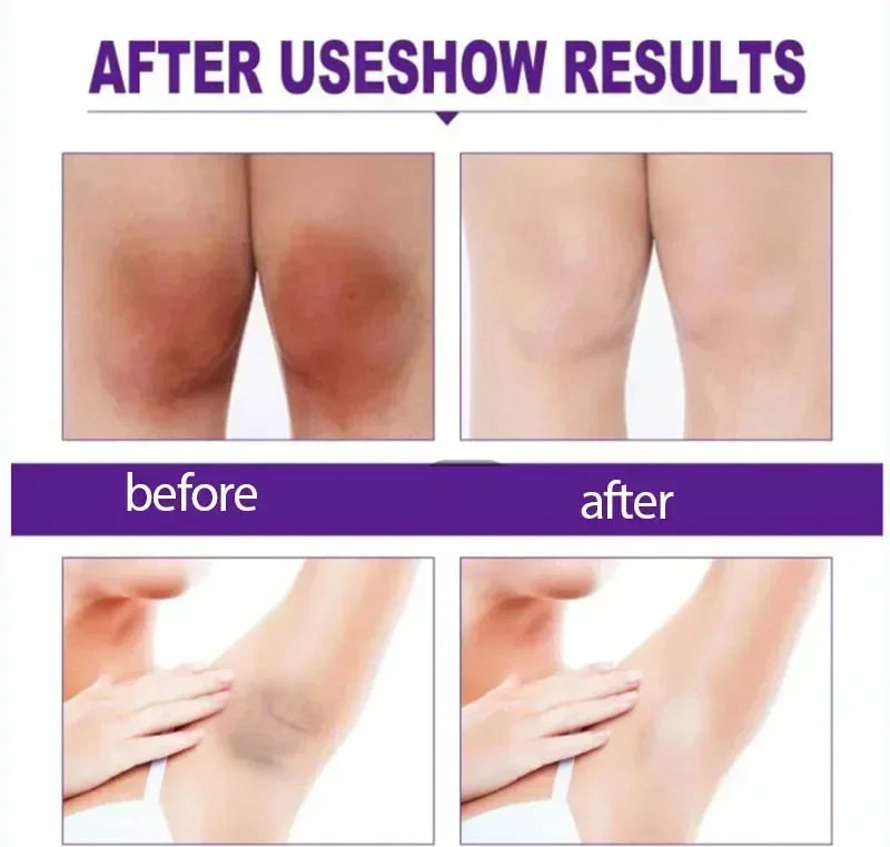 Whitening Cream Private Parts Underarm Bleaching Whiten Butt Knee Brighten Inner Thigh Intimate Parts Dark Remove Melanin