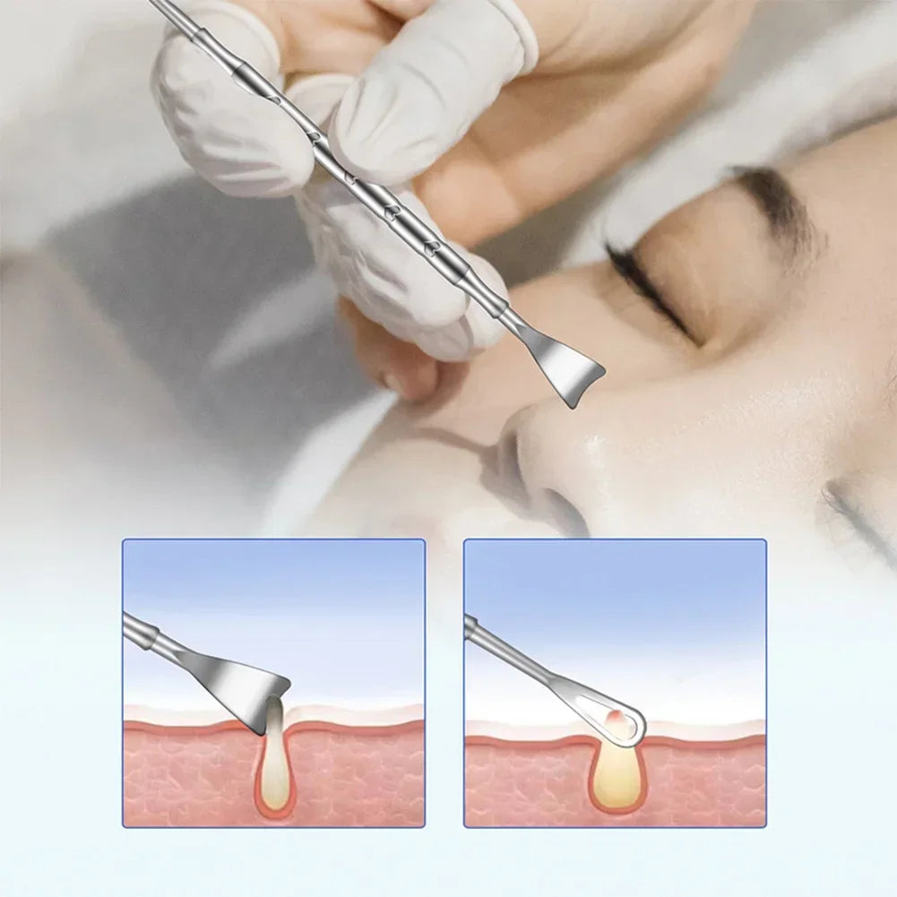 Blackhead Remover Pimple Popper Tool Acne Needle Removing Treatment Comedone Whitehead Popping Zit Nose Face Blemish Extractor