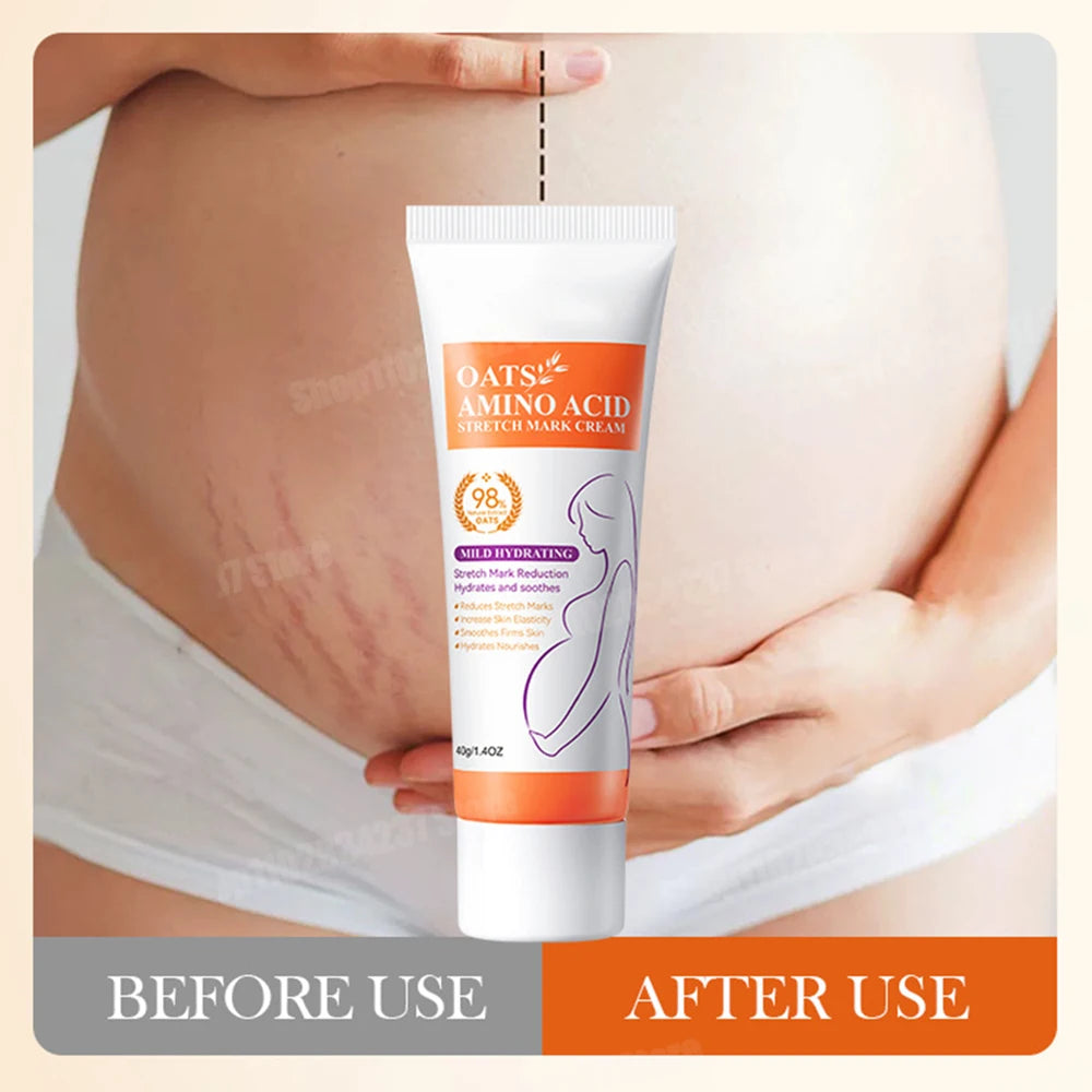Stretch Marks Removal Cream Light Lines Postpartum Obesity Pregnancy Powerful Fast Absorption