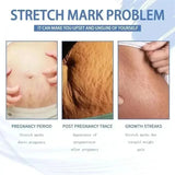 Cream For Pregnancy Stretch Marks Removal Eliminate Red White Old Stretch Marks  2025