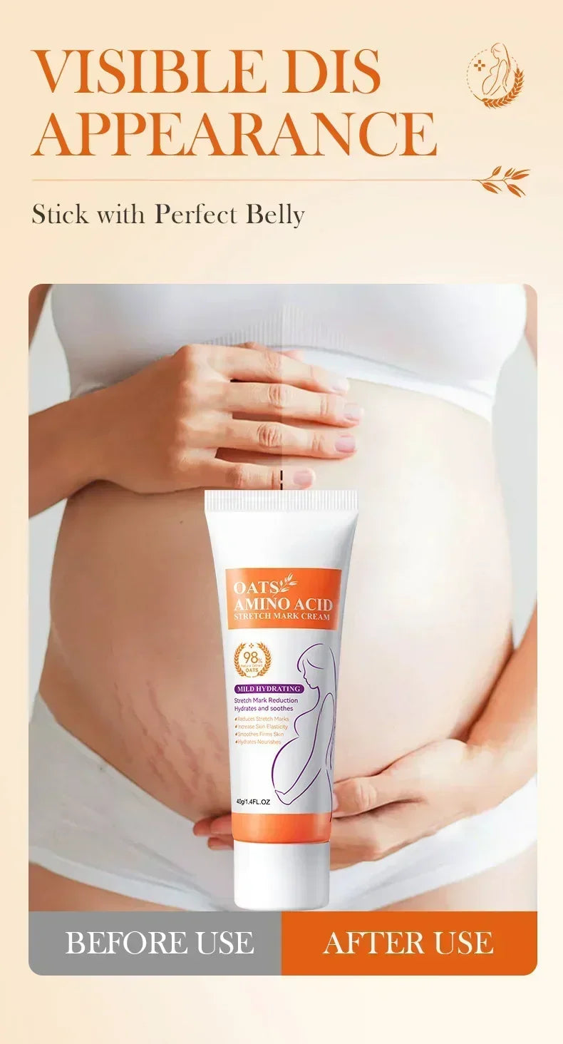 Cream For Pregnancy Stretch Marks Removal Eliminate Red White Old Stretch Marks  2025