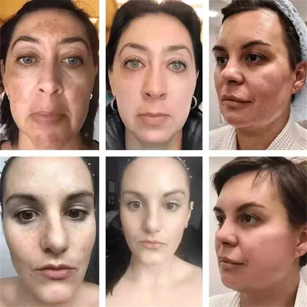Powerful Dark Spots Remover Whitening Serum Face Freckle Melanin Correcting Anti Pigmentation Brighten Skin Beauty Care Essence