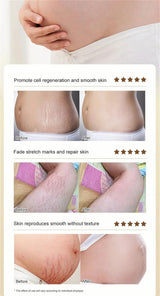 Stretch Marks Remover Essential Oil Pregnancy Maternity Body New Old Stretch Mark Removal Serum Increase Elasticity of Skin
