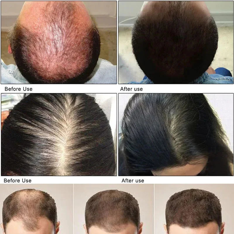 Hair Growth Serum 7 Days Fast Regrowth Essential Capsule Anti Hair Loss Baldness Repair Damaged Scalp Treatment For Women Men