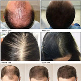Hair Growth Serum 7 Days Fast Regrowth Essential Capsule Anti Hair Loss Baldness Repair Damaged Scalp Treatment For Women Men