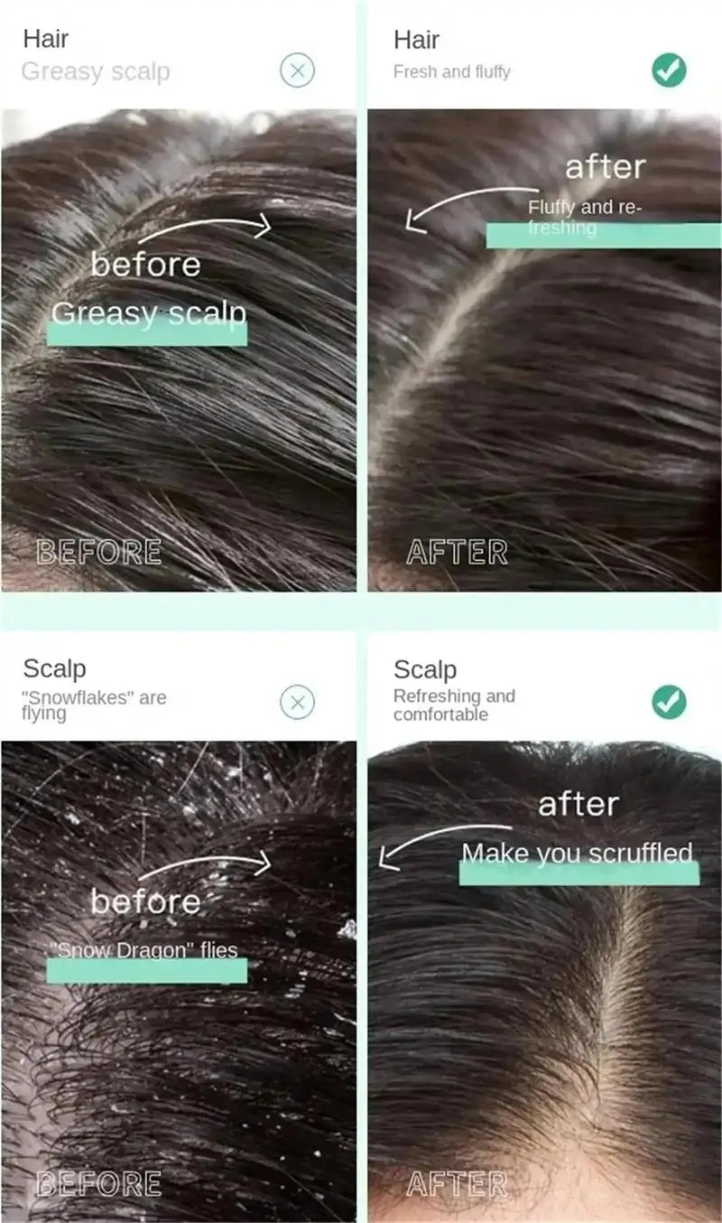 Fast Anti Exfoliating Scrub Remove Dandruff Anti Itching Treatment Seborrheic Scalp Oil Control Repair Scalp Beauty Health Care